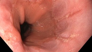 Schleimhautentzündung der Speiseröhre bei chronischer Refluxerkrankung